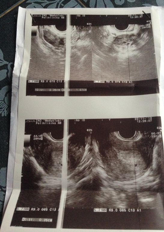 Не выдержала пошла на узи . Задержка 8 дней