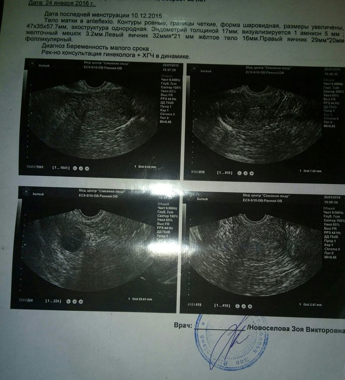 Матка поднялась. Жёлтое тело диаметром 5 мм. УЗИ беременности 5 недель эндометрий. УЗИ 4 недели беременности желтое тело.
