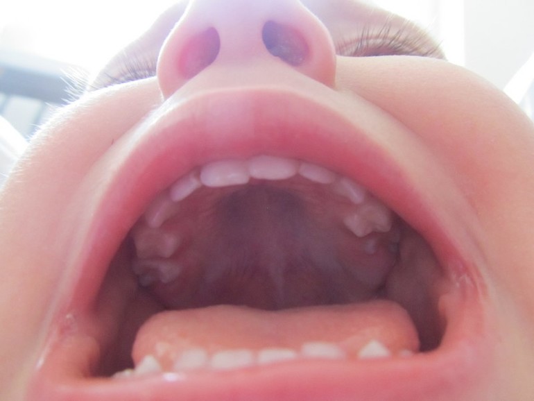 Как вылечить зубки?