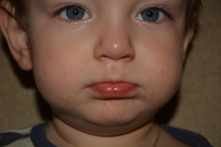 Что за прыщики?!