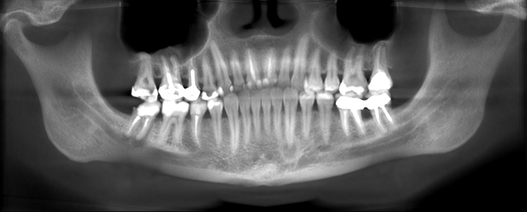 Гранулемы у взрослого. Как срочно лечить?