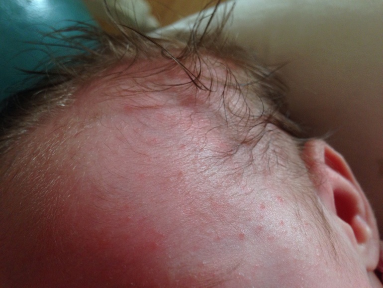 Что это за сыпь такая?