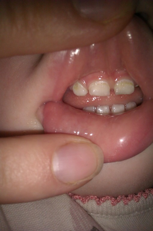 Разрушаются зубы.