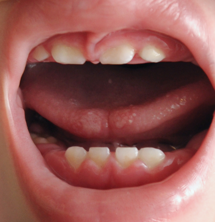 Налёт на зубках, кровоточат дёсны