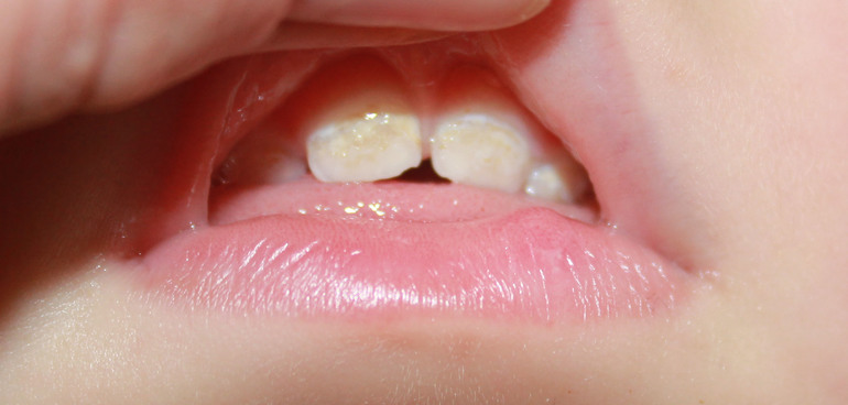 Налёт на верхних резцах