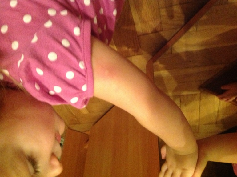 Кожная реакция на Гепатиты А и Б!!!