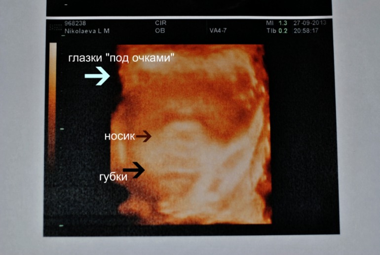 Узи 30 недель и 6 дней