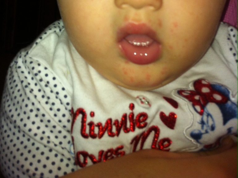 Сыпь, что это может быть и чем помазать?