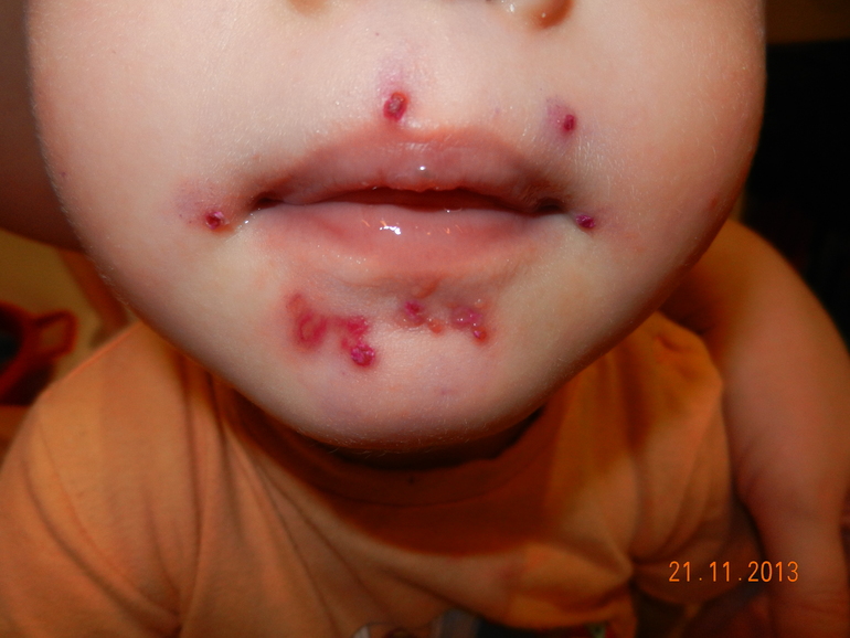 Стрептодермия..