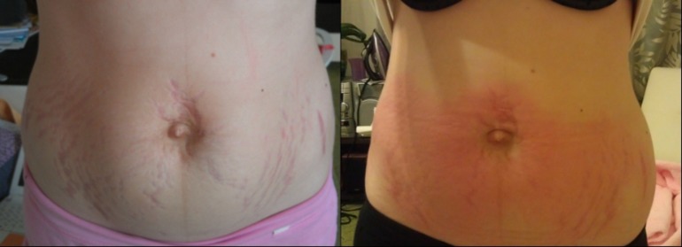 продолжаю бороться более активно)