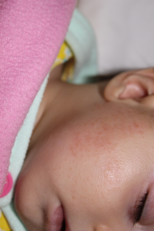 Вот и мы аллергики :(