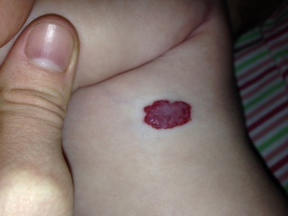 Наша гемангиома...