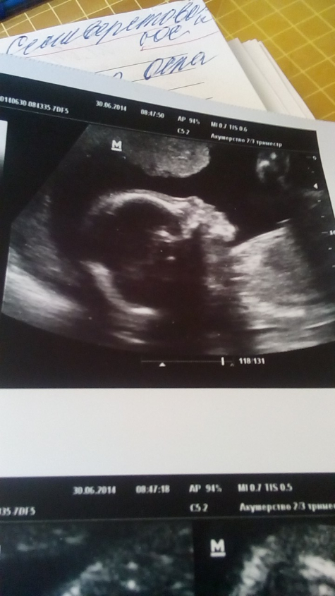 Узи 6 месяцев. Снимки УЗИ. Снимки УЗИ беременности. Снимок ребенка на УЗИ 2 недели.