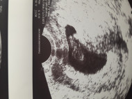 Фото УЗИ на 9 неделе беременности
