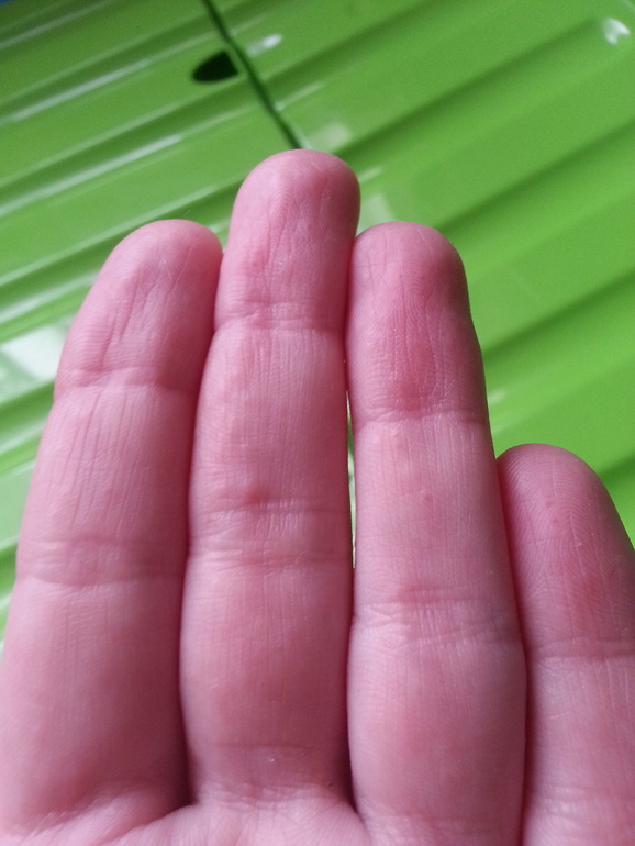 Подкожные прыщи на ладонях — 41 ответов | форум Babyblog