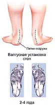 Формы ног и свод стоп ребенка