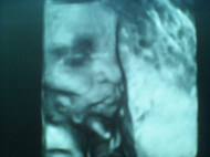 Фото УЗИ на 31 неделе беременности