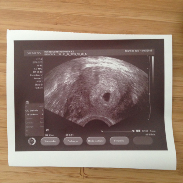 Неделя после зачатия узи. УЗИ на ранних сроках беременности 5 недель. Снимок УЗИ беременности на ранних сроках 5 недель. УЗИ беременности на ранних сроках 1-2 недели. Беременность на УЗИ на ранних сроках 2 неделя беременности.