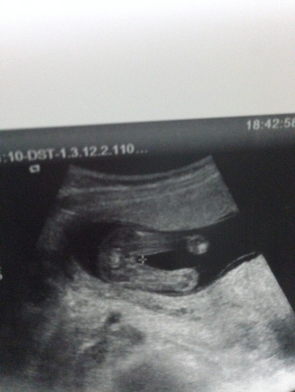 18 недель мальчик. УЗИ 18 недель беременности девочка. УЗИ 18 недель беременности мальчик.