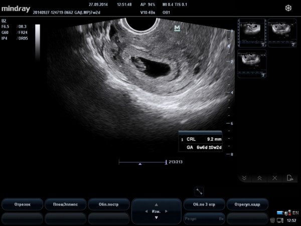 7 узи беременность. Семь недель беременности УЗИ. УЗИ на 7 неделе беременности. УЗИ 7 недель беременности фото. УЗИ беременной 7 недель.