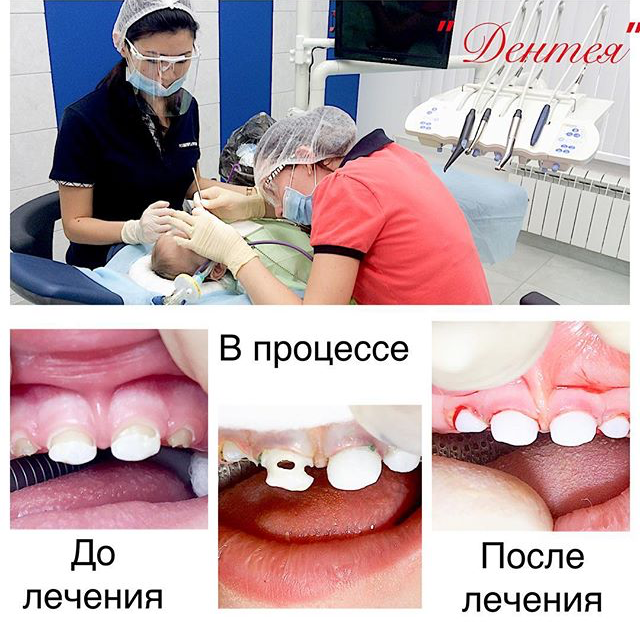 Лечение кариеса + реставрация передних зубов под общим наркозом Севоран ...
