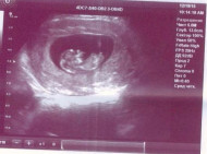 Фото УЗИ на 11 неделе беременности