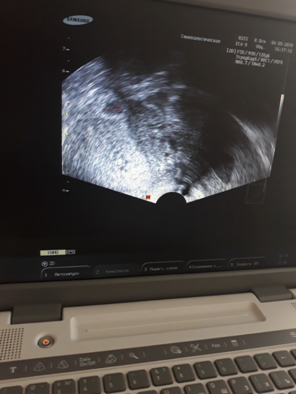 Узи 6 месяцев. Снимок УЗИ беременности 5-6 недель на мониторе УЗИ. УЗИ В 6 недель беременности УЗИ. УЗИ 6 недель беременности на мониторе.