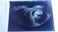Фото УЗИ на 10 неделе беременности