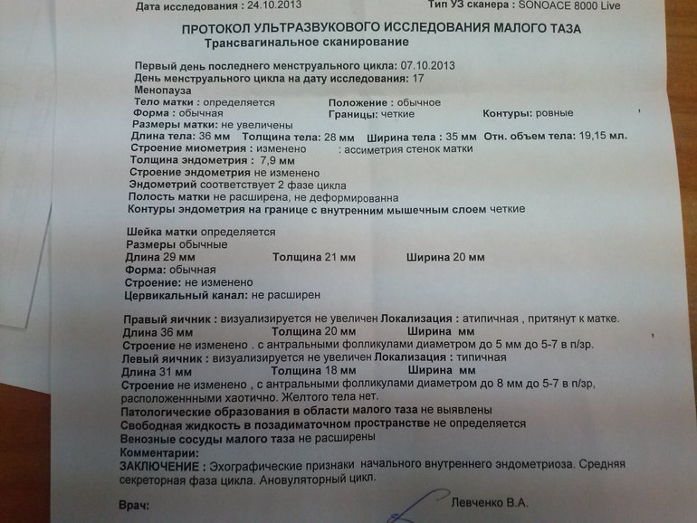 Эндометриоз , будь он не ладен!