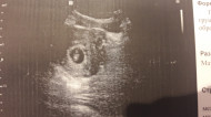 Фото УЗИ на 7 неделе беременности