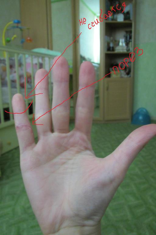 Как выглядит перелом мизинца на руке фото