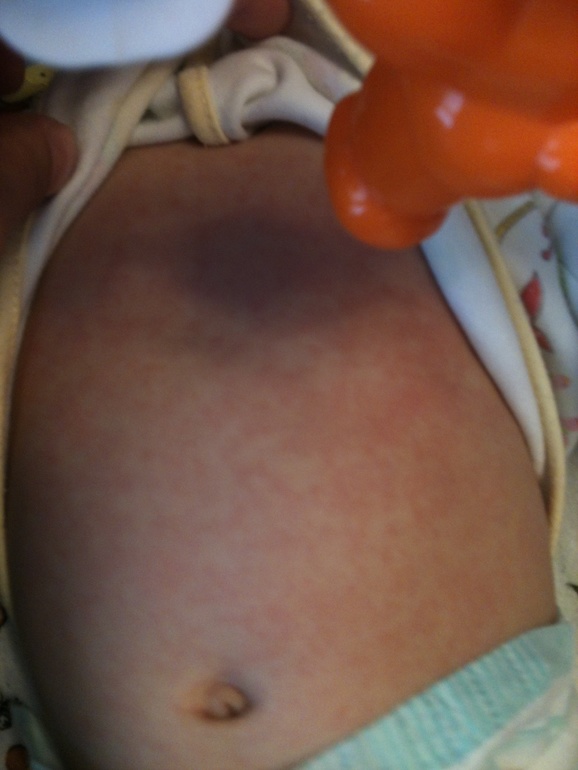 Покраснения