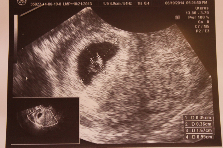 Посещение гинеколога. 6 неделька!