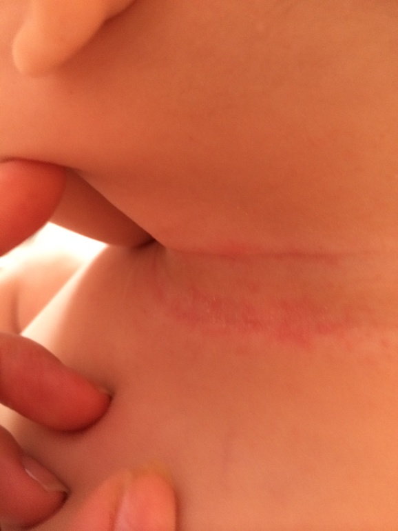 Это опрелость?