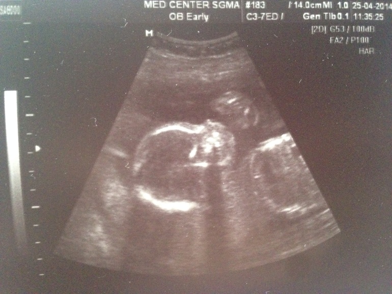 Узи 21 неделя +фото!