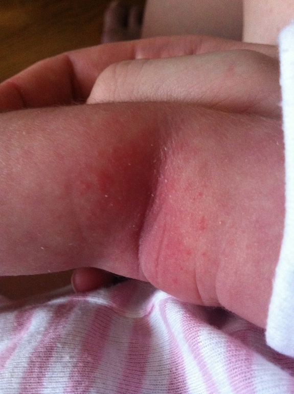 Потничка или аллергия?