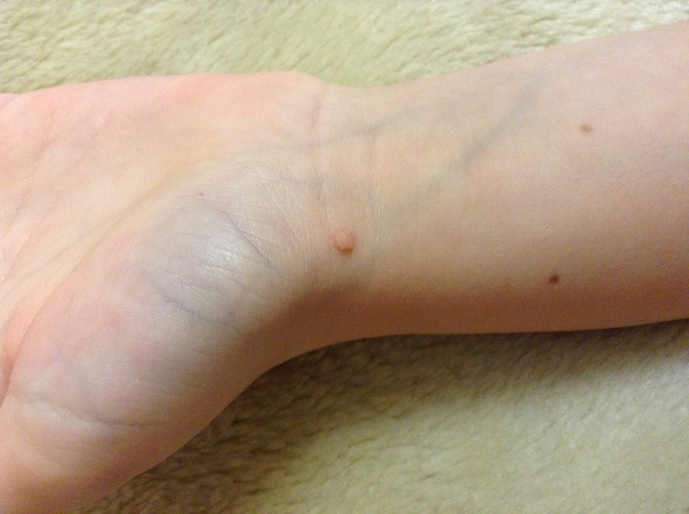 Папиллома/бородавка у дочки! Какие меры принять?