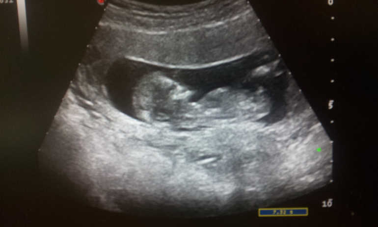 Беременность 12 недель мальчик