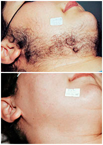 Элос эпиляция в Днепропетровске