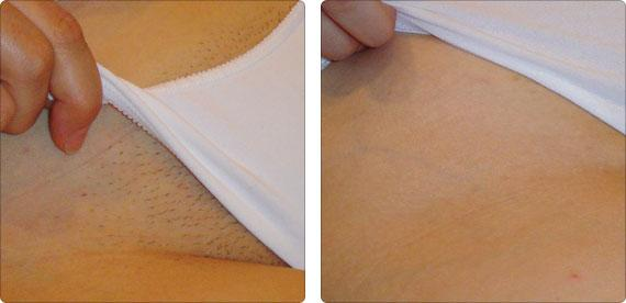 Элос эпиляция в Днепропетровске