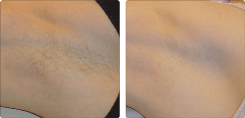 Элос эпиляция в Днепропетровске