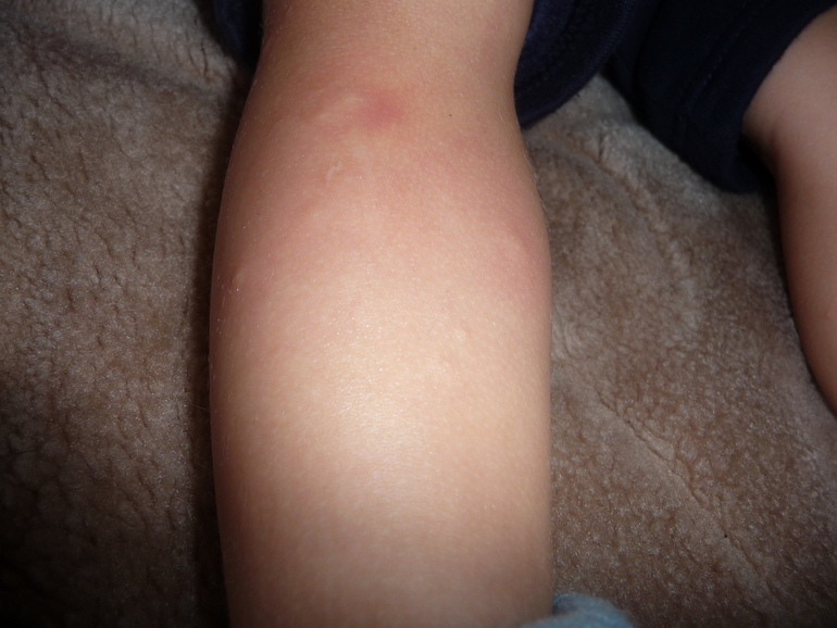 Как лечить аллергию?