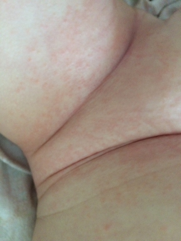 Аллергия на памперсы у ребенка: может ли быть, как выглядит, лечение