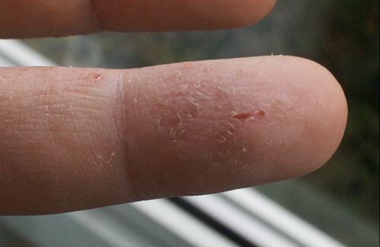 Эксфолиативный кератолиз - облазит кожа на руках причины и лечение