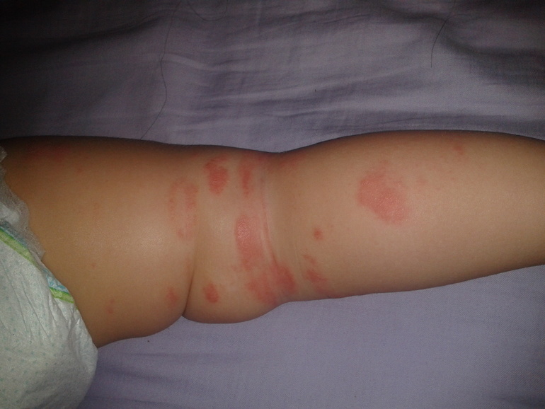 аллергия или нет?