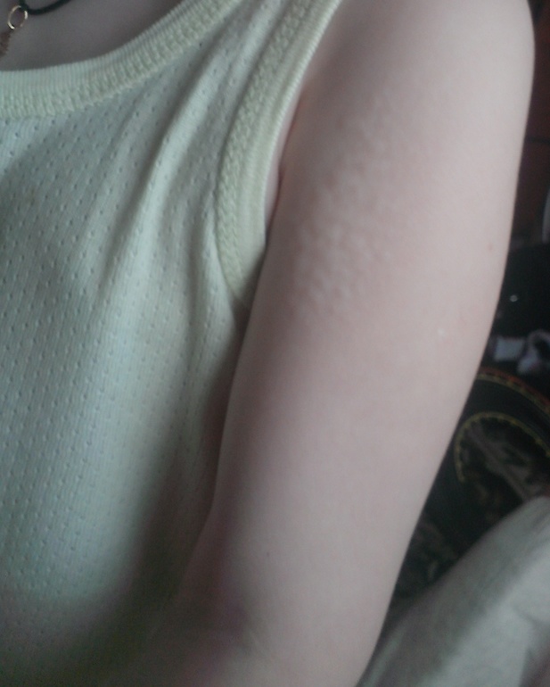 Вафельная кожа. Что это может быть?