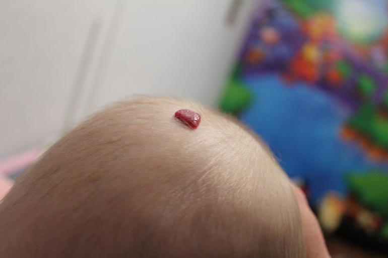 гемонгиома