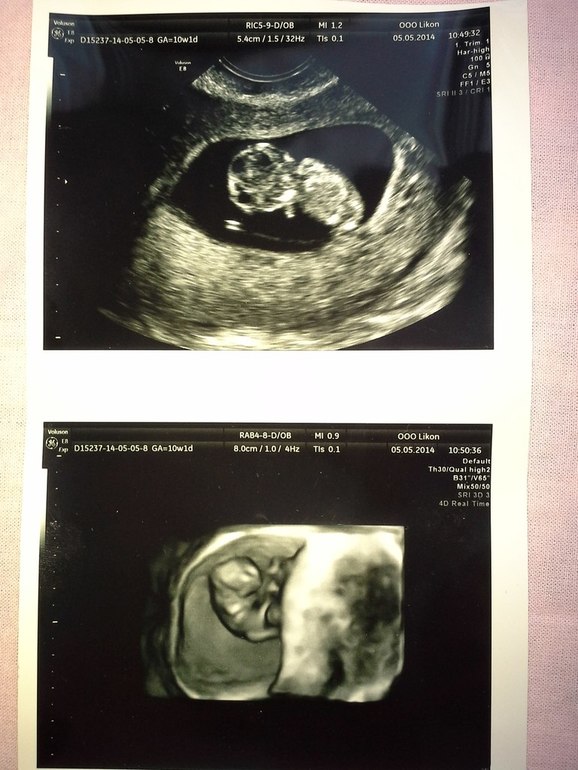 Поменьше слушайте врачей!!!