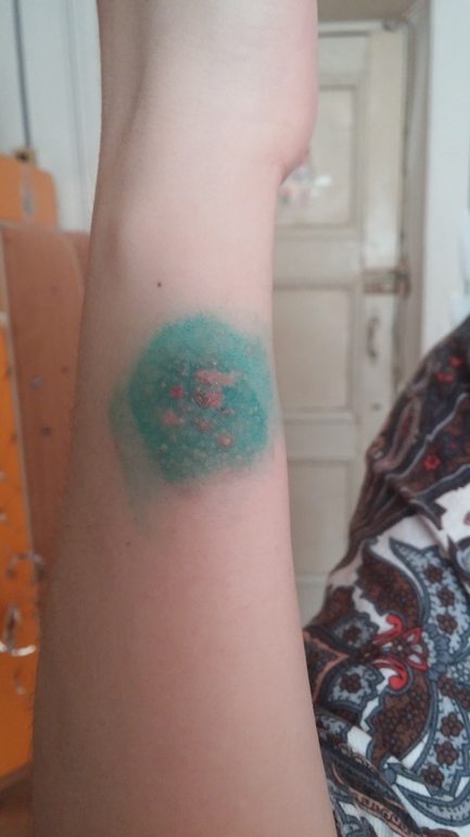 Герпес...очень страшно...