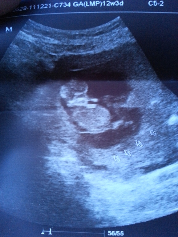 Сделала УЗИ.....